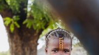 Sénégal : Une fillette de 4 ans capable de sourire pour la première fois après une intervention chirurgicale
